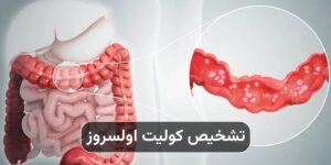 تشخیص کولیت اولسروز