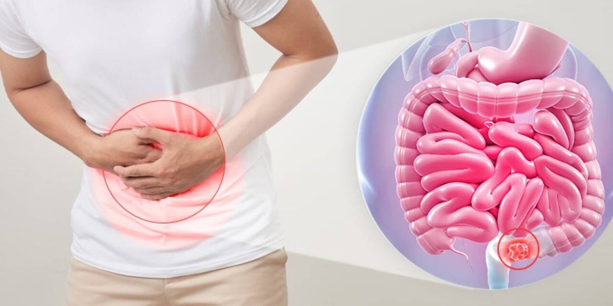 علائم بیماری کرون