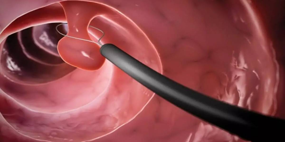 تفاوت EMR و ESD