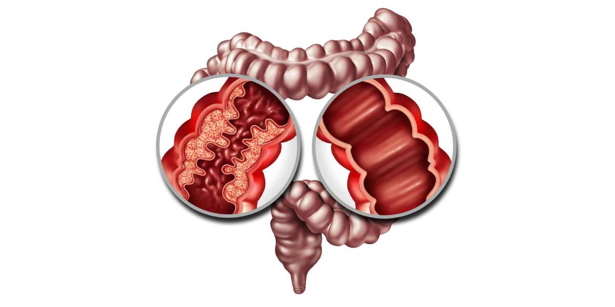 درمان بیماری کرون