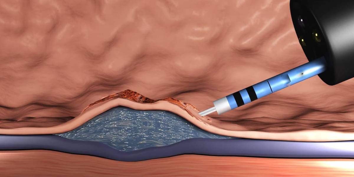 تفاوت EMR و ESD