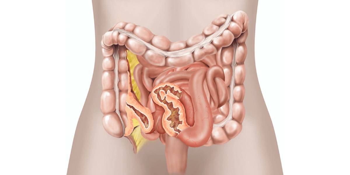 جراحی تخصصی کرون و کولیت اولسروز